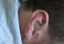 AKO VAS MUČI ZAČEPLJENO UHO, evo kako ga odčepiti prirodnim putem i bez puno boli GENIJALAN SAVJET