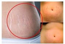 Uklonite Celulit i Strije Uz SAMO DVA SASTOJKA: PRIRODNI Recept za Glatku KOŽU