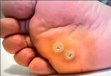 Napokon sam riješio problem sa kurjim okom koje mi nije dalo mira!