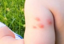 KOMARCI VAM PRAVE PAKAO OD ŽIVOTA? Isijecite OVO VOĆE na pola i ostavite u sobi, KOMARCI ĆE NESTATI ZAUVIJEK! !