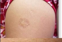 Svi rođeni u Jugoslaviji imaju ovaj ožiljak na ruci: Znate li kako je nastao i zbog čega? Svi su iznenađeni