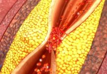 Kardiolog otkrio koja voćka najbolje čisti krvne sudove od triglicerida i holesterola: Svi je izbjegavaju, a munjevito razgrađuje masnoću!