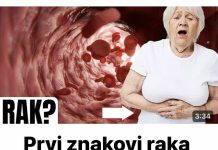 Ovo su prvi znakovi raka debelog crijeva koje žene ignoriraju- Na vrijeme saznajte! (FOTO)