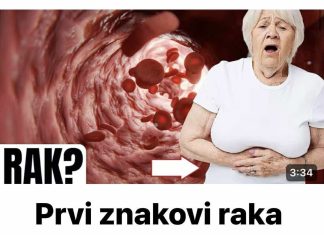 Ovo su prvi znakovi raka debelog crijeva koje žene ignoriraju- Na vrijeme saznajte! (FOTO)