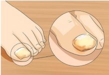 NAMAZALA SAM OVU SMJESU NA GLJIVICE NA NOKTIMA: Nestale su kao rukom odnesene, GENIJALAN RECEPT MI SPASIO ŽIVOT