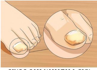 NAMAZALA SAM OVU SMJESU NA GLJIVICE NA NOKTIMA: Nestale su kao rukom odnesene, GENIJALAN RECEPT MI SPASIO ŽIVOT