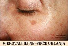 VJEROVALI ILI NE – SIRĆE UKLANJA BORE AKNE I STARAČKE PjEGE! Ovako se koristi!