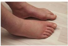 EVO ŠTA TREBA DA RADITE AKO VAŠE TIJELO ZADRŽAVA VODU: Sve što vam treba imate u kuhinji samo uzmite i… (FOTO)