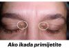 Ako ikada primjetite takve izrasline oko očiju, TREBALI BISTE ZNATI ŠTA ONI ZNAČE