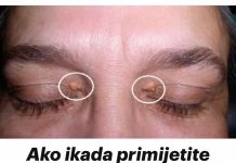 Ako ikada primjetite takve izrasline oko očiju, TREBALI BISTE ZNATI ŠTA ONI ZNAČE