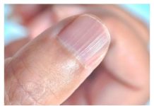 IMATE LI OVAKVE IZBOČINE NA NOKTIMA – pogledajte šta one znače!  Doktorica otkrila strašnu istinu! (FOTO)