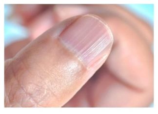 IMATE LI OVAKVE IZBOČINE NA NOKTIMA – pogledajte šta one znače! Doktorica otkrila strašnu istinu! (FOTO)