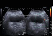 RAK BUBREGA IMA OVIH 6 SIMPTOMA: VEOMA TEŠKO SE PREPOZNAJU: Posebno obratite pažnju na broj 2 (FOTO)