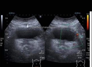 RAK BUBREGA IMA OVIH 6 SIMPTOMA: VEOMA TEŠKO SE PREPOZNAJU: Posebno obratite pažnju na broj 2 (FOTO)