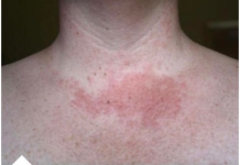 Primijećujete li ove promjene na svom licu ili vratu: Poznati doktor otkrio šta vam se dešava! (FOTO)