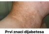 Evo koji su prvi znakovi dijabetesa koji ljudi često ignorišu godinama!