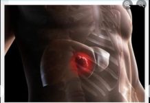 Rak jetre ima veoma prepoznatljive simptome:: Ovo su 4 faze razvoja opakog tumora! (FOTO)