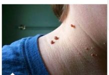 NERVIRAJU VAS SITNE BRADAVICE NA KOŽI? Evo kako da ih brzo uklonite uz pomoć jedne namirnice!