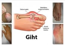 UZ POMOĆ OVOGA IZBACITE M0KRAĆNU KISELINU IZ TIJELA: Prirodni napitak za liječenje GIHTA (RECEPT)