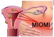 PRVI SIMPTOM MIOMA MATERICE: Žene ako ovo uočite – ODMAH kod ginekologa!