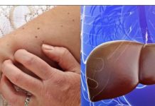 AKO UOČITE OVE SIMPTOME ODMAH SE JAVITE DOKTORU! Ovo si sigurni znakovi da je došlo do OŠTEĆENJA JETRE….