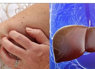 AKO UOČITE OVE SIMPTOME ODMAH SE JAVITE DOKTORU! Ovo si sigurni znakovi da je došlo do OŠTEĆENJA JETRE….