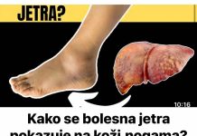 Evo kako se bolesna jetra pokazuje na koži,nogama? OVO SU PRVI SIMPTOMI BOLESNE JETRE… (FOTO)