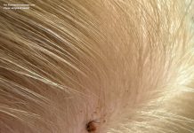 Upravo sam ovo otkrila u kosi mog dijeta… Da li treba da idemo kod lekara… šta je ovo?