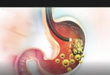 5 ranih simptoma raka želuca: Tumor može da raste godinama, a svi pacijenti prvo osjete ovo… 5 ranih simptoma raka želuca: Tumor može da raste godinama, a svi pacijenti prvo osjete ovo… - featured image