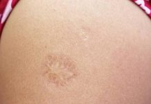 Ako ste rođeni u SFRJ, imate ožiljak od vakcine na ramenu. Znate li zašto se stvorio taj ožiljak? OBJAŠNJENJE. (VIDEO)